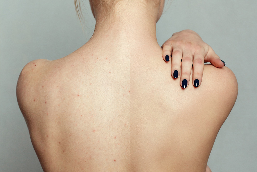 Resultado peeling quimico espalda